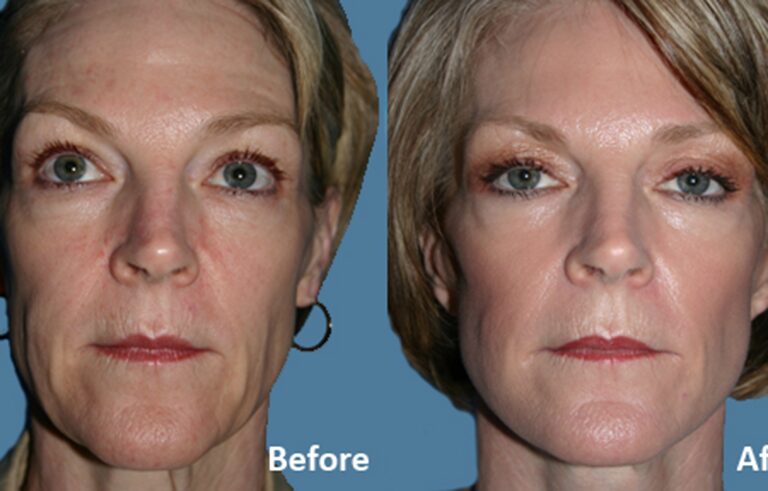 Facelift before and after photo by Midwest Facial Plastic Surgery in Minnesota