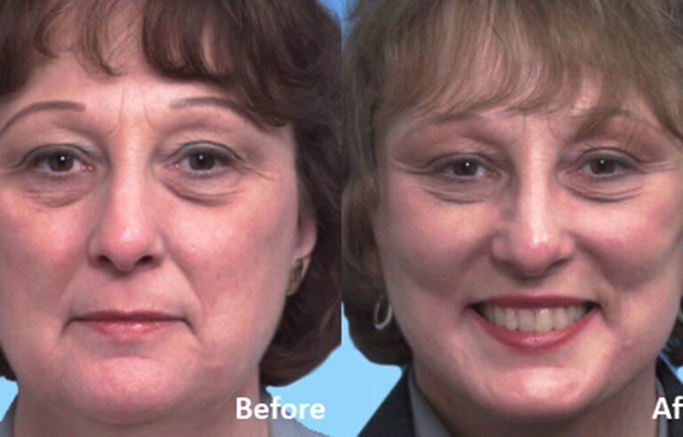 Facelift before and after photo by Midwest Facial Plastic Surgery in Minnesota