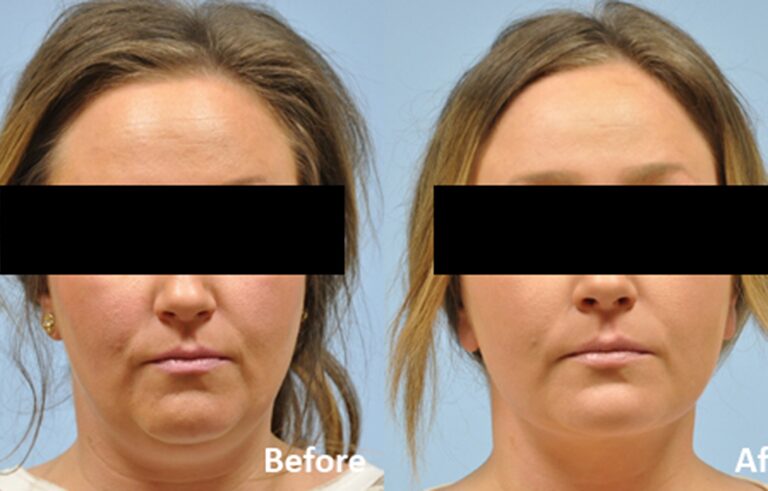 Neck Lift before and after photo by Midwest Facial Plastic Surgery in Minnesota