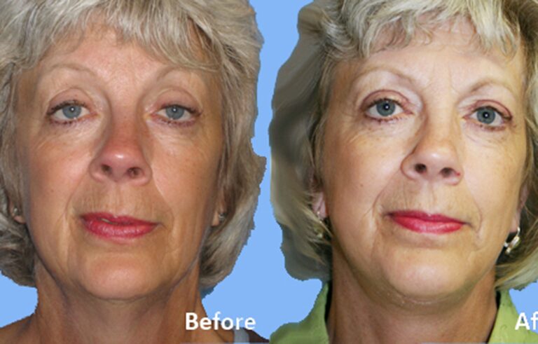 Neck Lift before and after photo by Midwest Facial Plastic Surgery in Minnesota