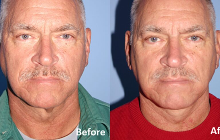 Neck Lift before and after photo by Midwest Facial Plastic Surgery in Minnesota