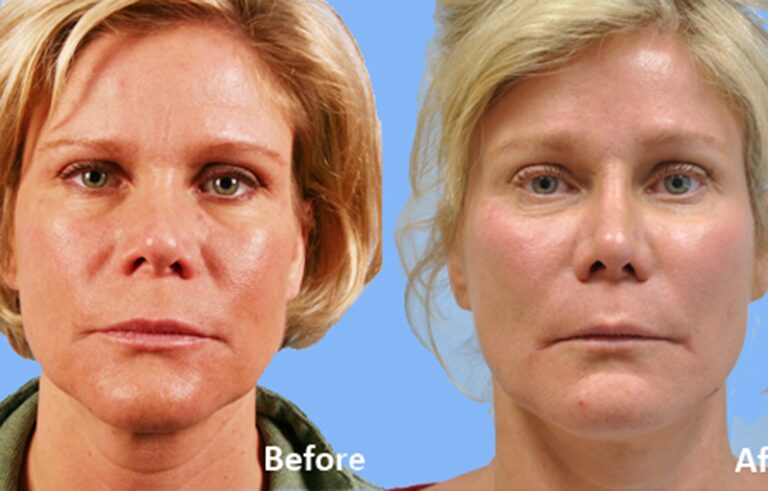 Neck Lift before and after photo by Midwest Facial Plastic Surgery in Minnesota