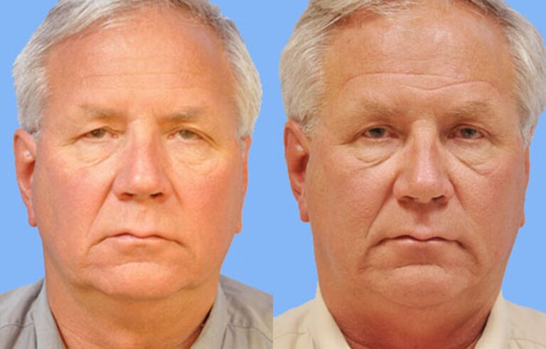 Eyelid Surgery before and after photo by Midwest Facial Plastic Surgery in Minnesota