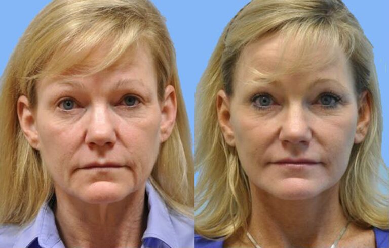 Facelift before and after photo by Midwest Facial Plastic Surgery in Minnesota