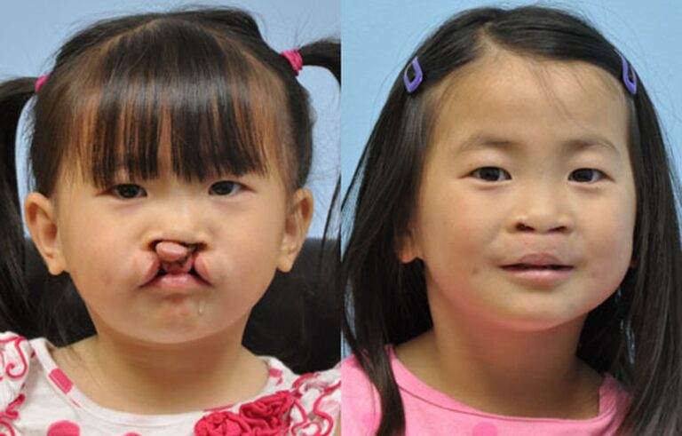 Cleft Lip Nose before and after photo by Midwest Facial Plastic Surgery in Minnesota