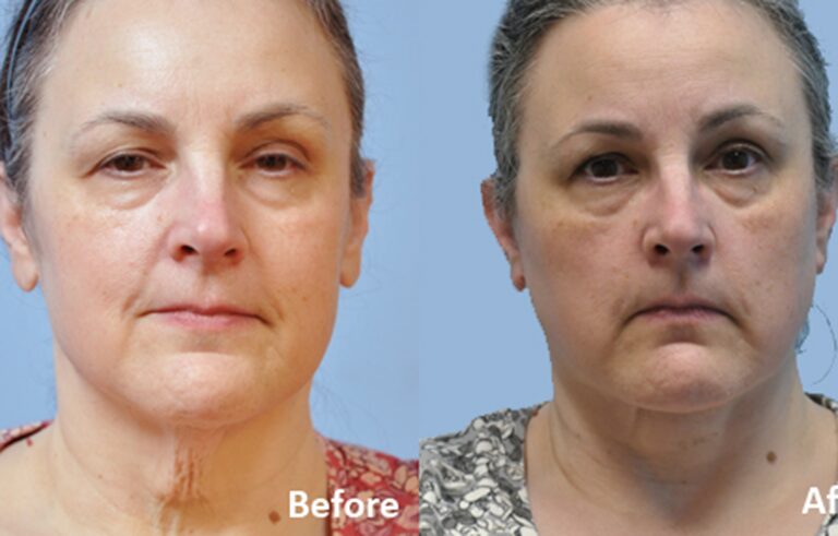 Neck Lift before and after photo by Midwest Facial Plastic Surgery in Minnesota