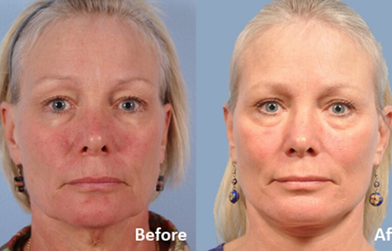 Facelift before and after photo by Midwest Facial Plastic Surgery in Minnesota