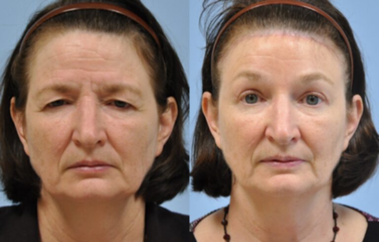 Eyelid Surgery before and after photo by Midwest Facial Plastic Surgery in Minnesota