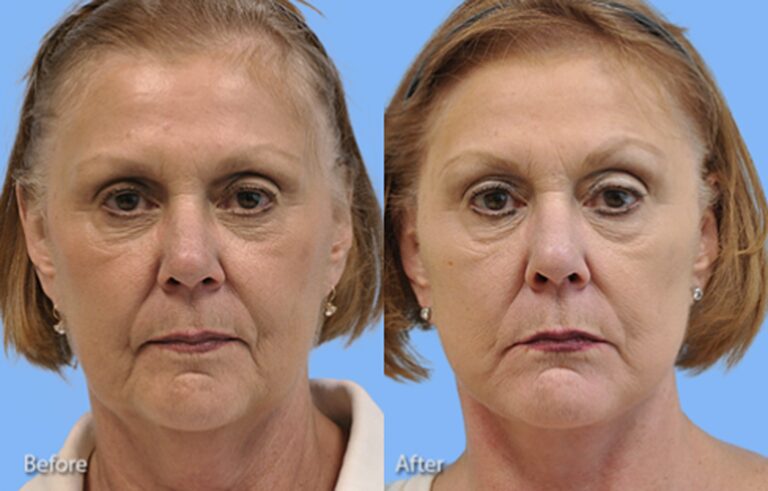 Facelift before and after photo by Midwest Facial Plastic Surgery in Minnesota