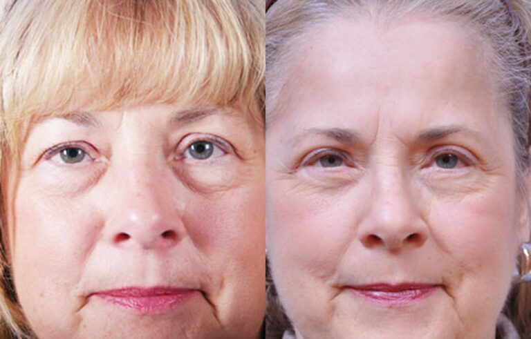 Eyelid Surgery before and after photo by Midwest Facial Plastic Surgery in Minnesota