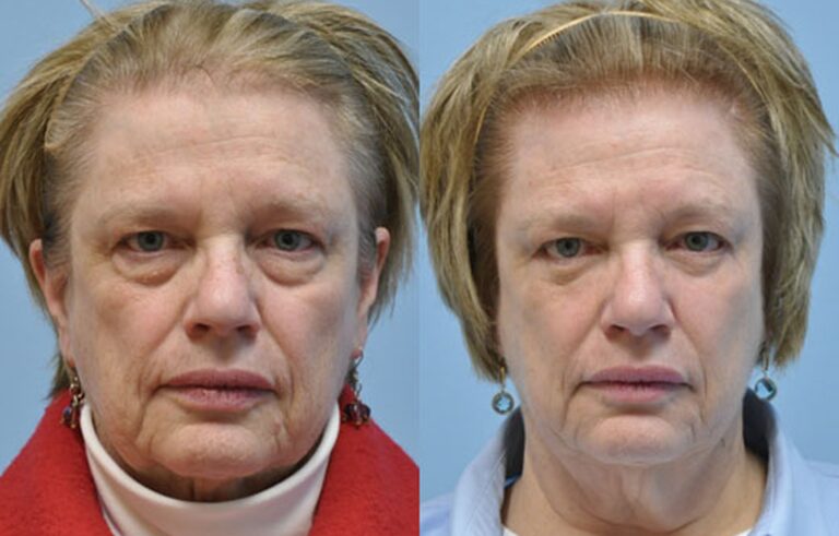 Eyelid Surgery before and after photo by Midwest Facial Plastic Surgery in Minnesota