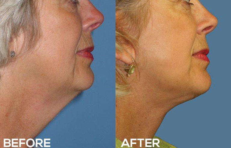 Neck Lift before and after photo by Midwest Facial Plastic Surgery in Minnesota