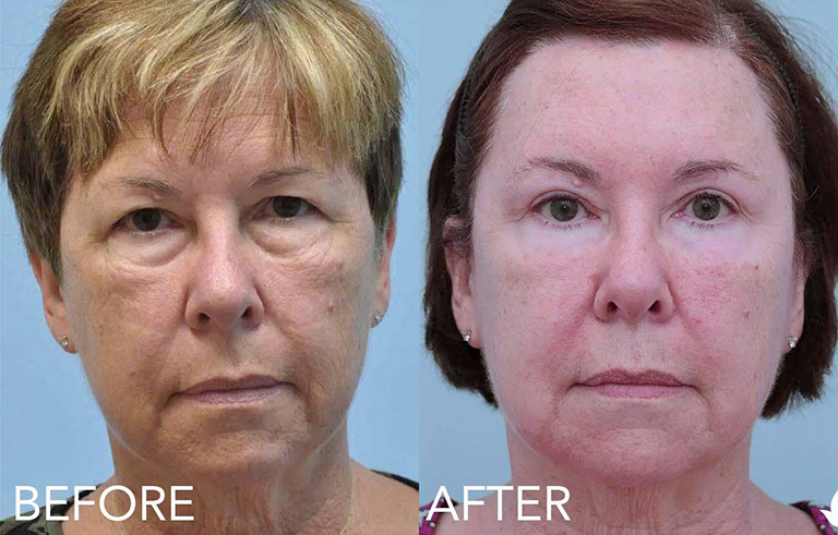 Eyelid Surgery before and after photo by Midwest Facial Plastic Surgery in Minnesota