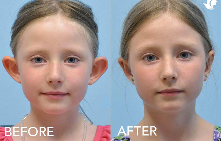 Otoplasty Ear Reconstruction before and after photo by Midwest Facial Plastic Surgery in Minnesota