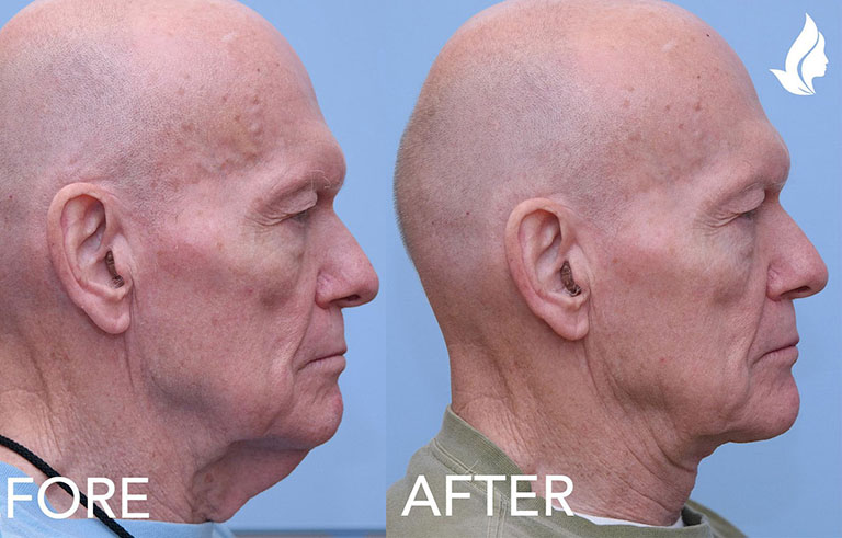 Neck Lift before and after photo by Midwest Facial Plastic Surgery in Minnesota