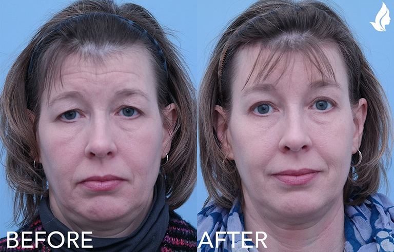 Eyelid Surgery before and after photo by Midwest Facial Plastic Surgery in Minnesota