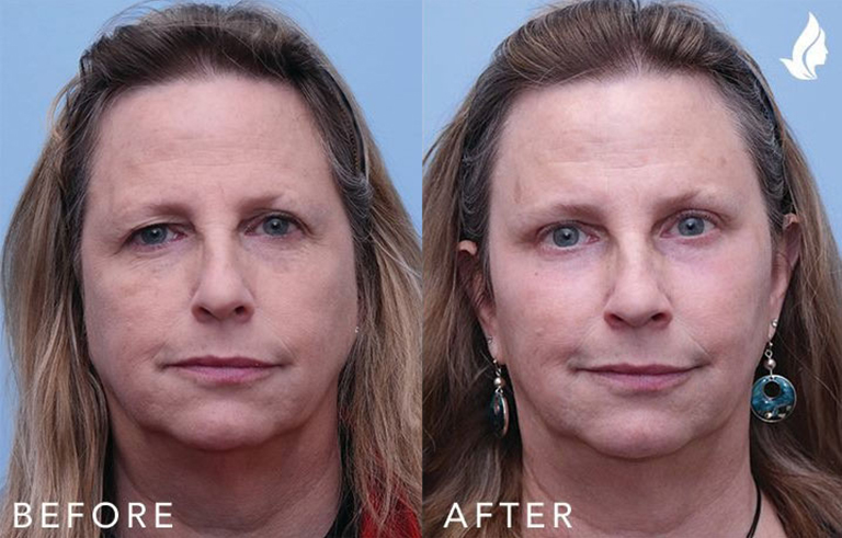 Eyelid Surgery before and after photo by Midwest Facial Plastic Surgery in Minnesota