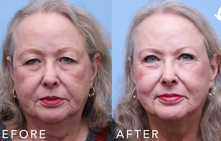 Eyelid Surgery before and after photo by Midwest Facial Plastic Surgery in Minnesota