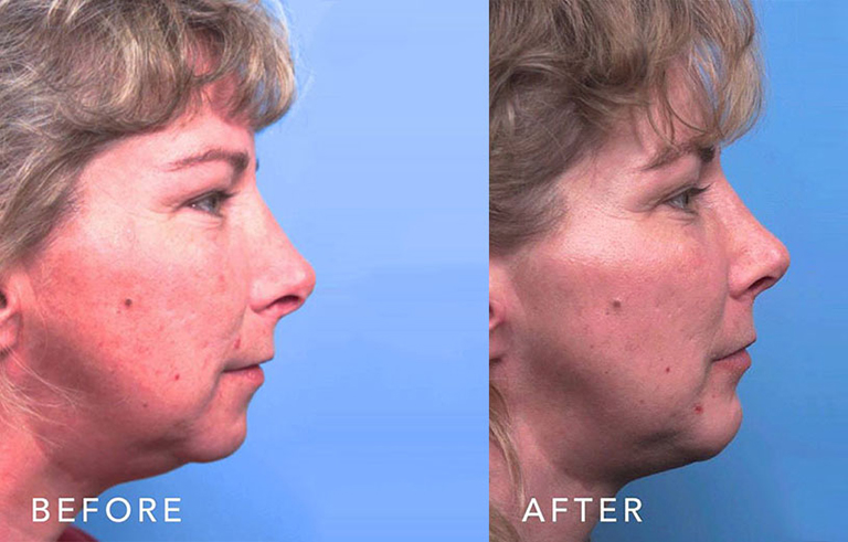 Facial Implants Chin Augmentation before and after photo by Midwest Facial Plastic Surgery in Minnesota