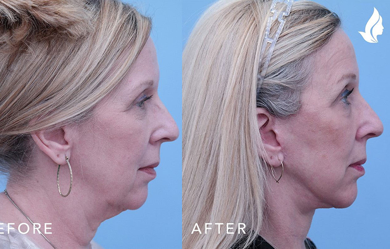 Facelift before and after photo by Midwest Facial Plastic Surgery in Minnesota