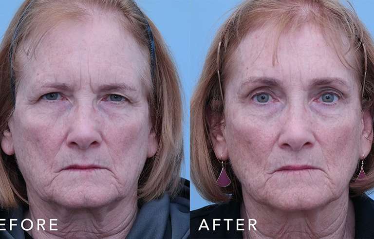 Eyelid Surgery before and after photo by Midwest Facial Plastic Surgery in Minnesota