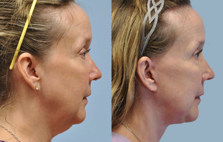 Facelift before and after photo by Midwest Facial Plastic Surgery in Minnesota