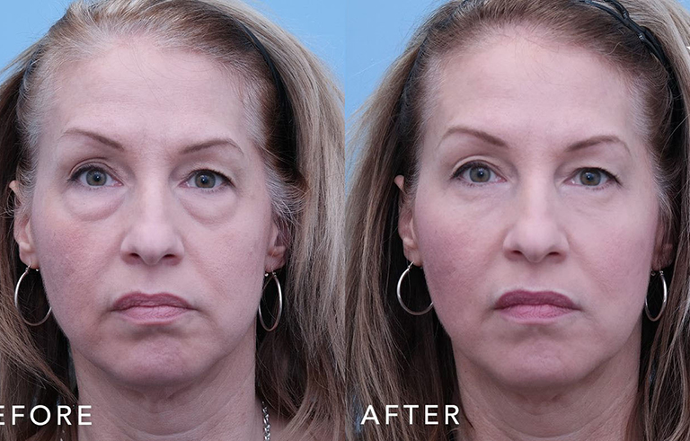 Eyelid Surgery before and after photo by Midwest Facial Plastic Surgery in Minnesota