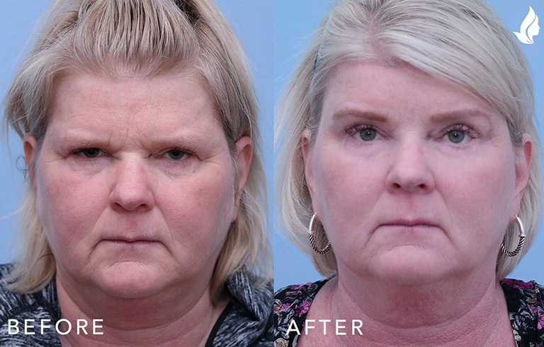 Eyelid Surgery before and after photo by Midwest Facial Plastic Surgery in Minnesota