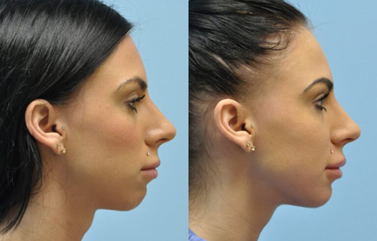 Facial Implants Chin Augmentation before and after photo by Midwest Facial Plastic Surgery in Minnesota