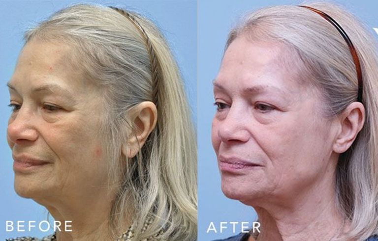 Otoplasty Ear Reconstruction before and after photo by Midwest Facial Plastic Surgery in Minnesota