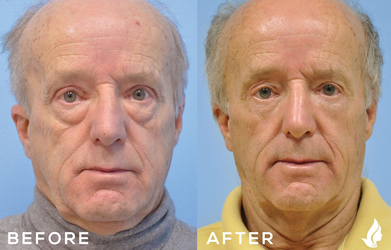 Eyelid Surgery before and after photo by Midwest Facial Plastic Surgery in Minnesota