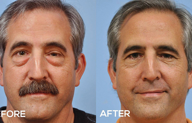 Eyelid Surgery before and after photo by Midwest Facial Plastic Surgery in Minnesota