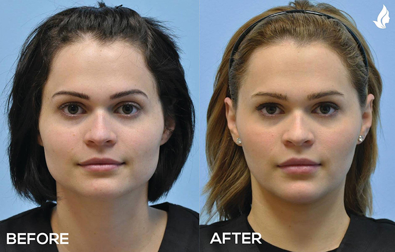 Lip Augmentation before and after photo by Midwest Facial Plastic Surgery in Minnesota