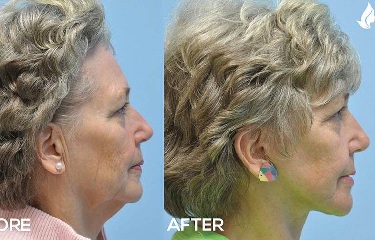 Facelift before and after photo by Midwest Facial Plastic Surgery in Minnesota