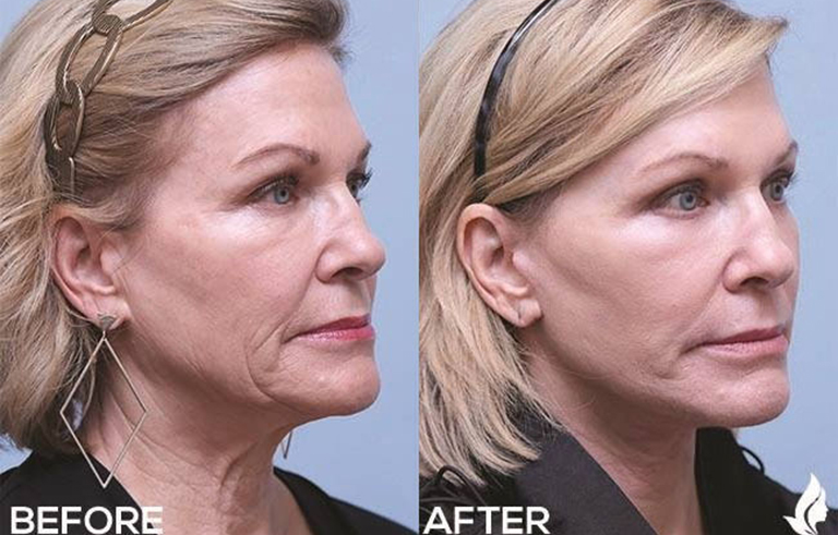 Eyelid Surgery before and after photo by Midwest Facial Plastic Surgery in Minnesota