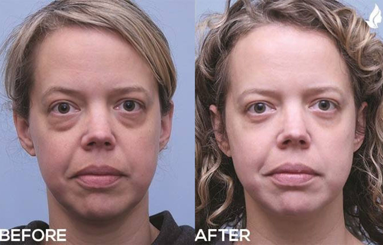 Eyelid Surgery before and after photo by Midwest Facial Plastic Surgery in Minnesota