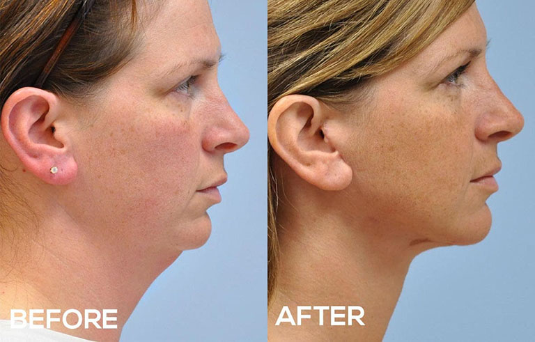 Neck Lift before and after photo by Midwest Facial Plastic Surgery in Minnesota