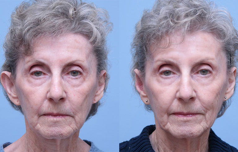 Otoplasty Ear Reconstruction before and after photo by Midwest Facial Plastic Surgery in Minnesota