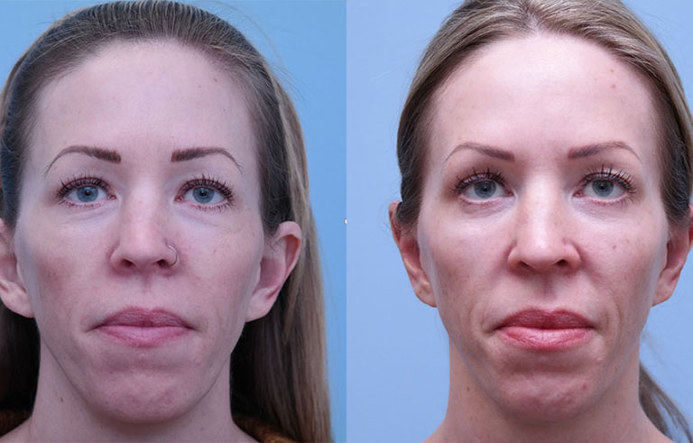 Otoplasty Ear Reconstruction before and after photo by Midwest Facial Plastic Surgery in Minnesota