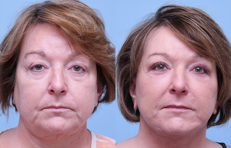 Facelift before and after photo by Midwest Facial Plastic Surgery in Minnesota