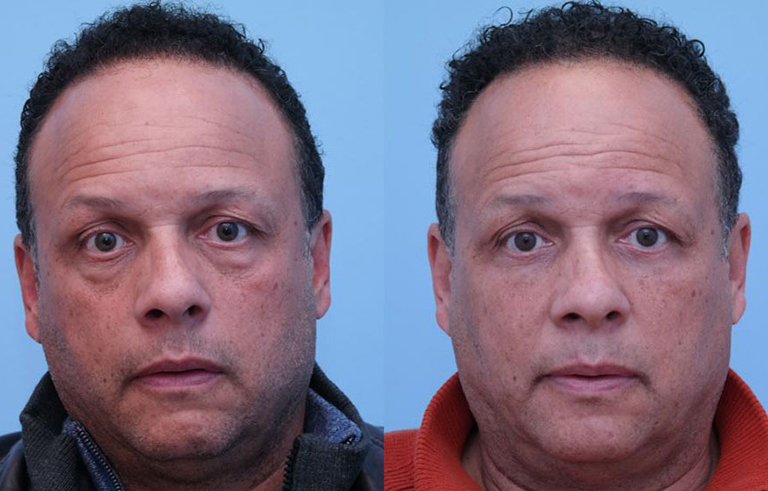 Eyelid Surgery before and after photo by Midwest Facial Plastic Surgery in Minnesota