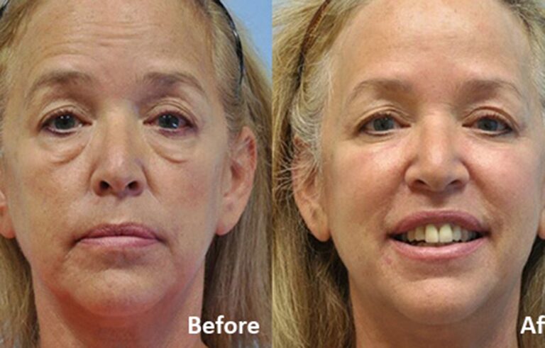 Eyelid Surgery before and after photo by Midwest Facial Plastic Surgery in Minnesota