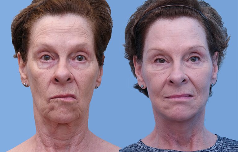 Facelift before and after photo by Midwest Facial Plastic Surgery in Minnesota