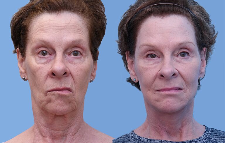 Neck Lift before and after photo by Midwest Facial Plastic Surgery in Minnesota