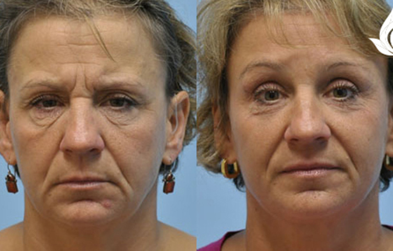 Brow Forehead Lift before and after photo by Midwest Facial Plastic Surgery in Minnesota