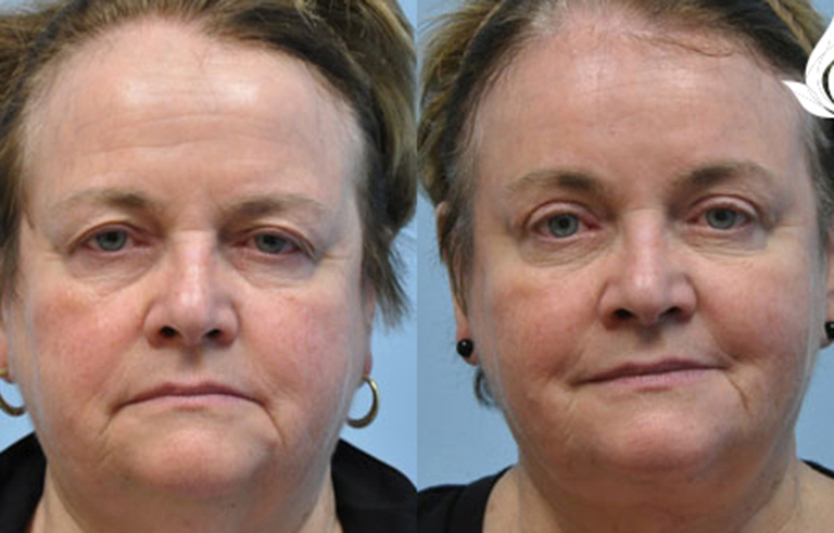 Brow Forehead Lift before and after photo by Midwest Facial Plastic Surgery in Minnesota