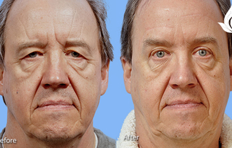 Brow Forehead Lift before and after photo by Midwest Facial Plastic Surgery in Minnesota