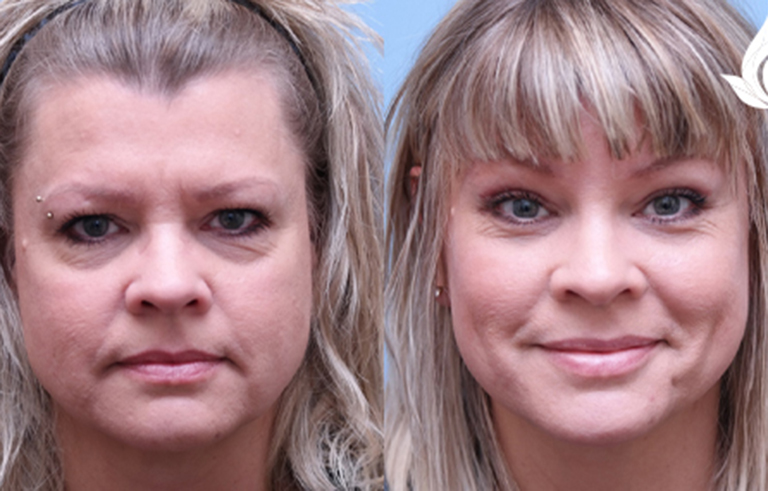 Brow Forehead Lift before and after photo by Midwest Facial Plastic Surgery in Minnesota