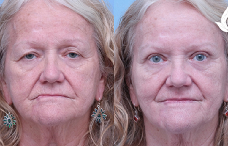 Brow Forehead Lift before and after photo by Midwest Facial Plastic Surgery in Minnesota