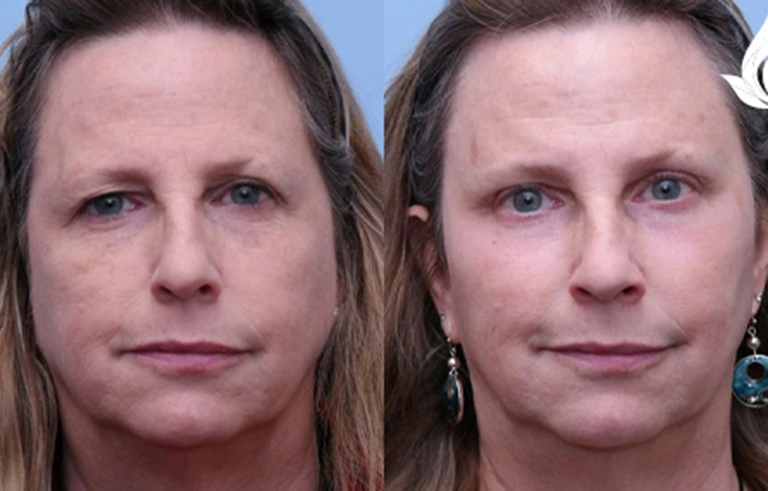 Brow Forehead Lift before and after photo by Midwest Facial Plastic Surgery in Minnesota